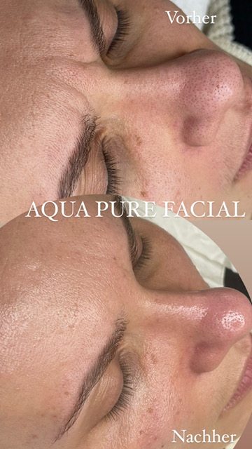 Vorher / Nachher – Aqua Pure Facial in Meerbusch